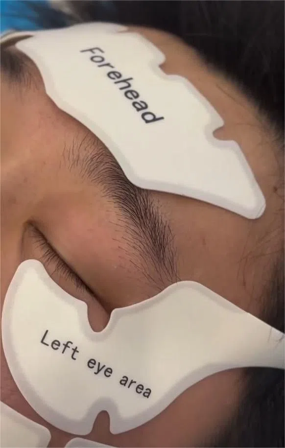 Розташування накладок EMSlim Face&Body PRO на чолі та навколо ока.